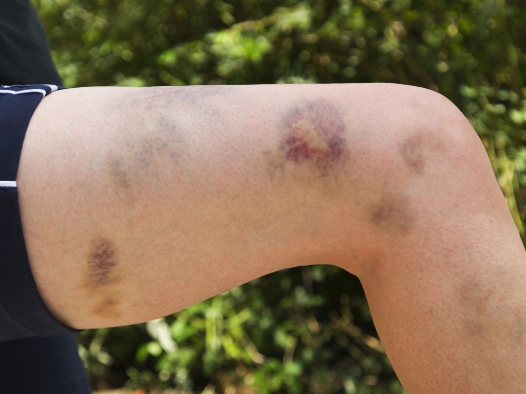 liver disease bruising