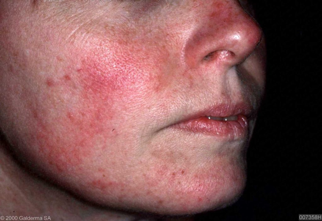 menopause rosacea