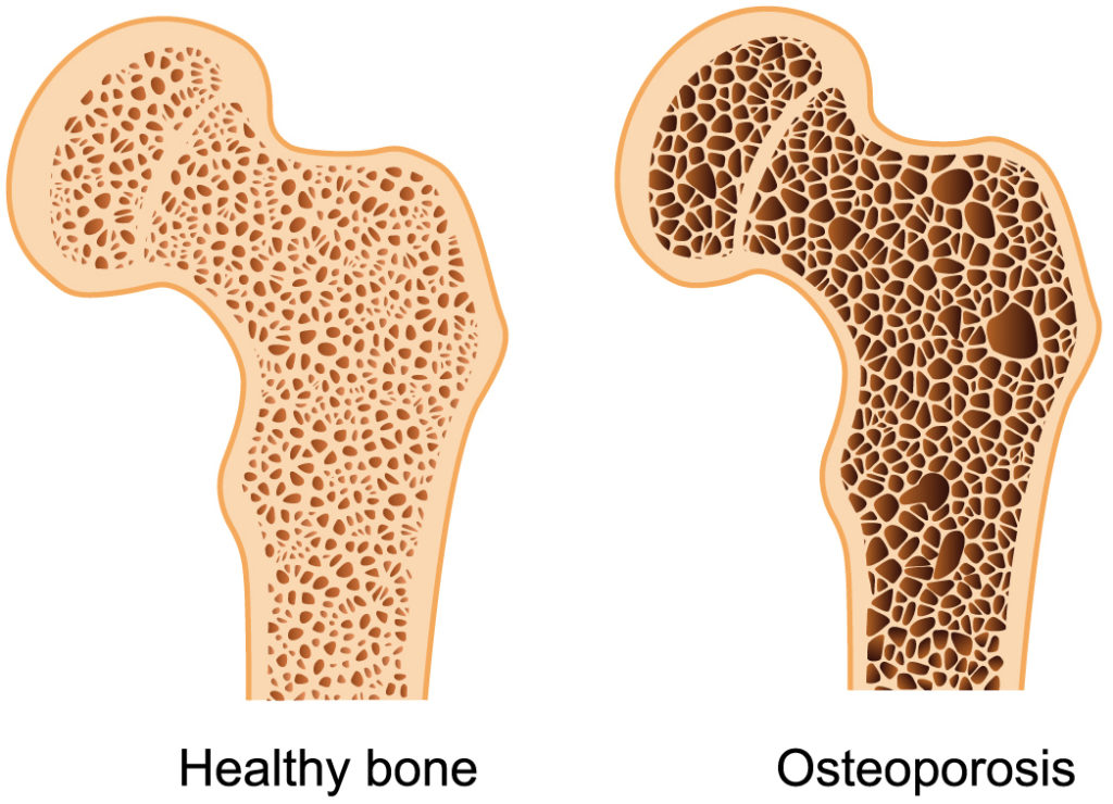 menopause osteoporosis