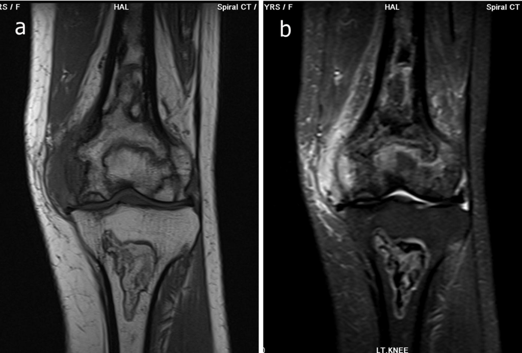 sickle cell disease bone infarct necrosis