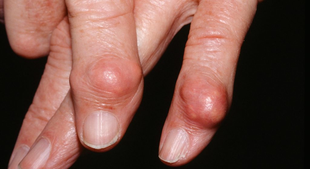 gout nodules